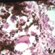 Melanoma, epithelioid Melanoma, epithelioid